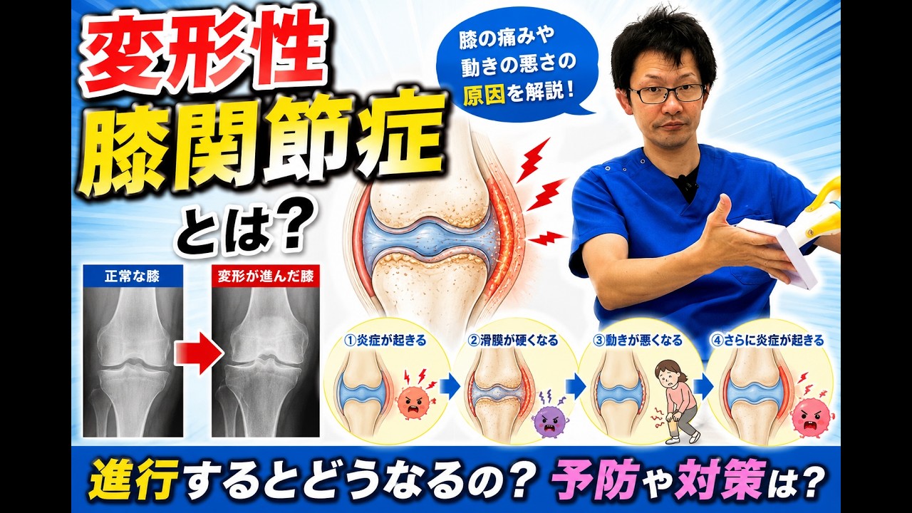 What is osteoarthritis of the knee? A diagrammatic explanation of