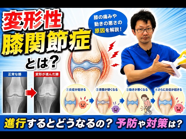 What is osteoarthritis of the knee? A diagrammatic explanation of