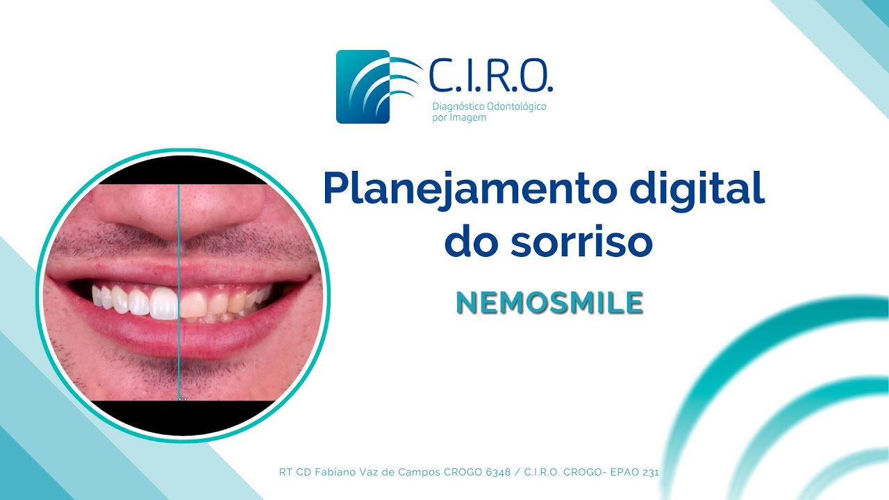 Planejamento digital do sorriso - NemoSmile