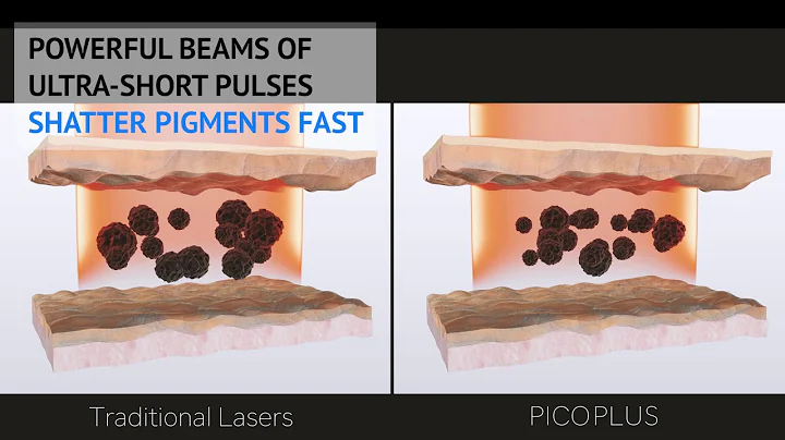 Pico Laser Pigmentation Treatment in Singapore | Sozo Aesthetic Clinic| Dr Justin Boey