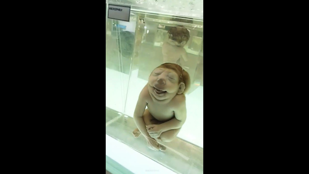 Different Types Of Congenital Anomalies In The Premature Infants Birthdefects