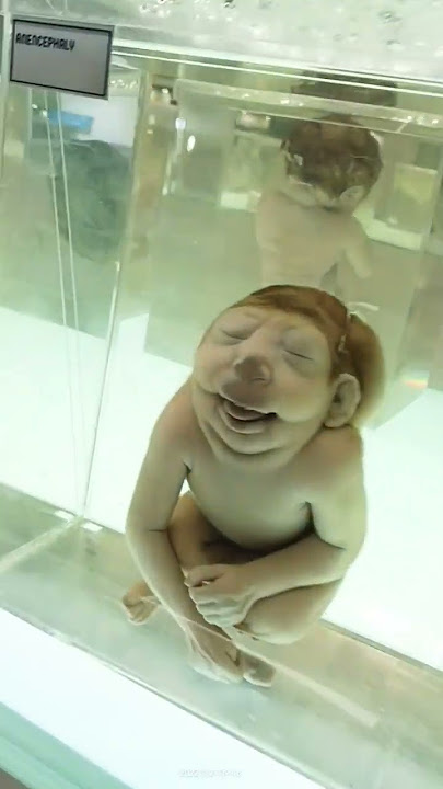 Different types of Congenital Anomalies in the premature infants. #Birthdefects