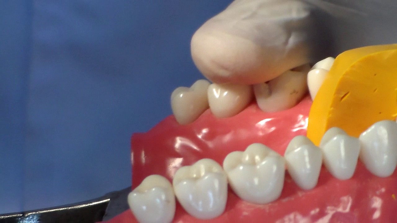 All Ceramic Jacket Crown Part 9 YouTube