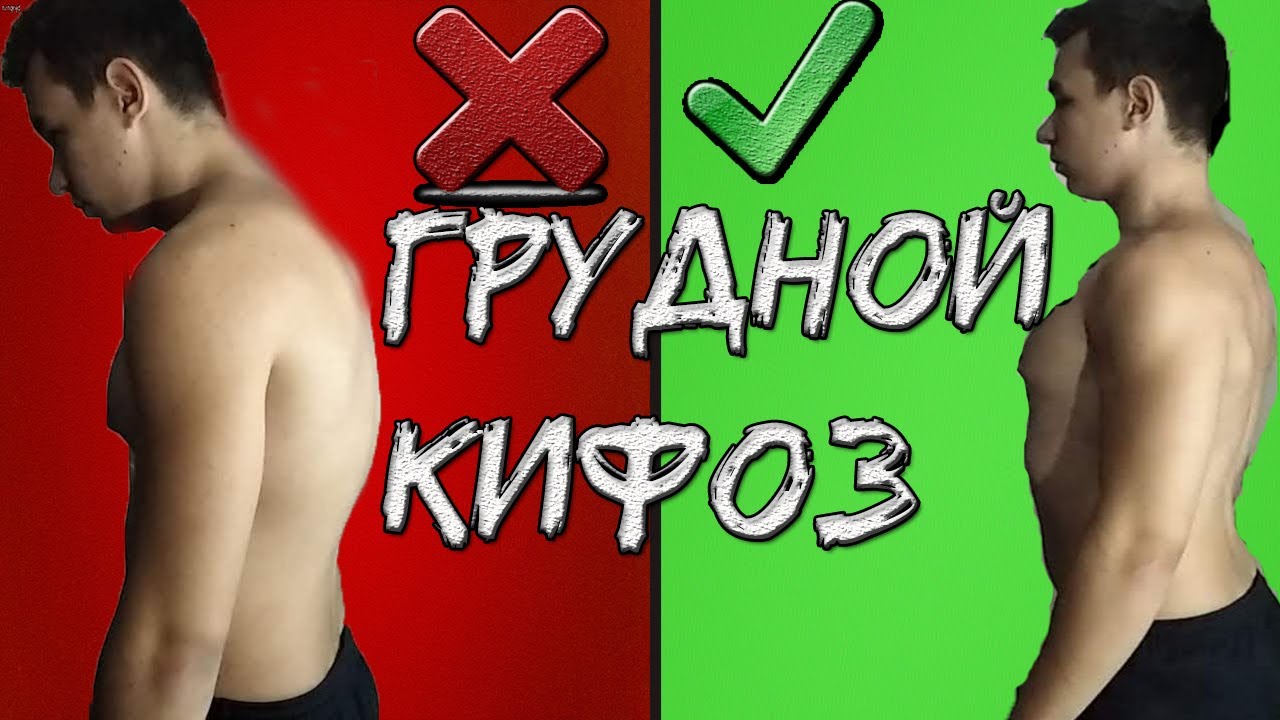 КАК ИСПРАВИТЬ ГРУДНОЙ КИФОЗ | (САМЫЙ БЫСТРЫЙ СПОСОБ) - YouTube