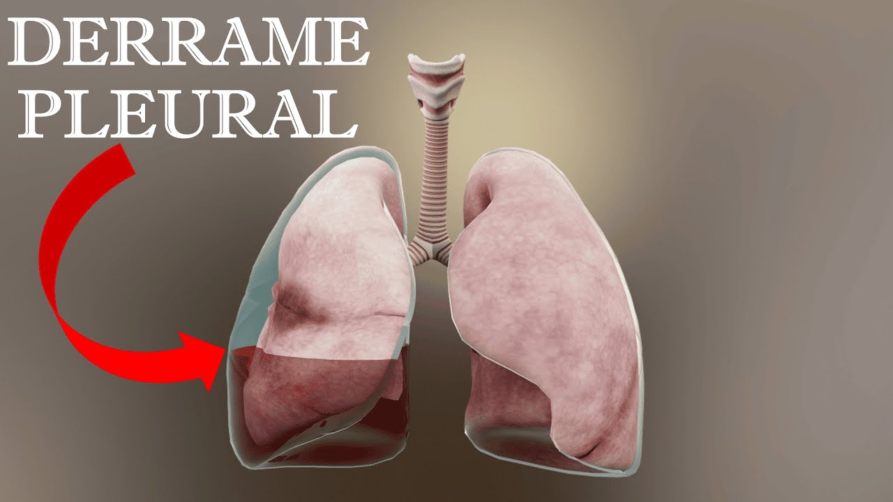 ¿QUÉ ES EL DERRAME PLEURAL? ¿POR QUÉ SE PRODUCE? CAUSAS, SÍNTOMAS, DIAGNÓSTICO Y TRATAMIENTO