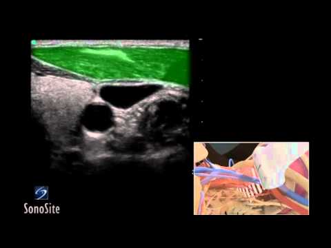 Extended Retrosigmoid Approach for Resection of Cystic Jugular Foramen Meningioma