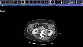 Edematosa ct pancreatitis aguda