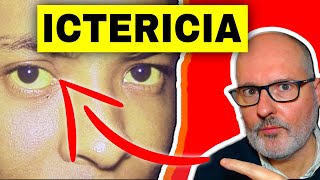 ¿Cuánto tiempo tarda en desaparecer la ictericia en adultos?