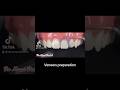 Veneers preparation dental veneers oralhealth smile dentist dentaltreatment viral teethwhite