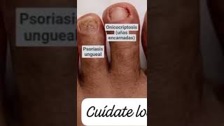 Patricio Feudale, podólogo. Especialista en pié diabético. Urgencias: 2616 566816. #PiesSanos