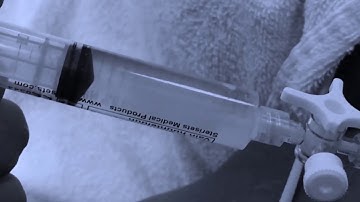 Ultrasound guided barbotage procedure for calcific tendinopathy of the shoulder