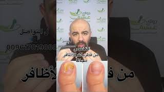 الحل السريع والمجاني ل التخلص من فطريات الأظافر شربل_معك_ما_بتفرق_معك