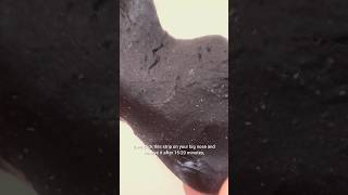 Sanfe Nose Strips Review 😱 | Blackhead Removal Test | Honest Review & Demo!" #shorts #shortfeed