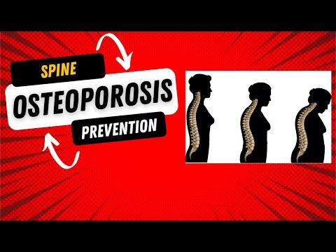 Decoding The Puzzle Of Spinal Osteoporosis Mr Ahmed Sadek Consultant Neurosurgeon