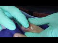 Ep_1578 Ingrown toenail removal 👣 กลั้นหายใจ..พี่ก็กลั้นใจเหมือนกัน 😝 (This clip is from Thailand)