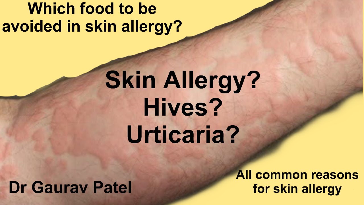 Skin Allergy Urticaria Reasons And Which Food To Be Avoided In