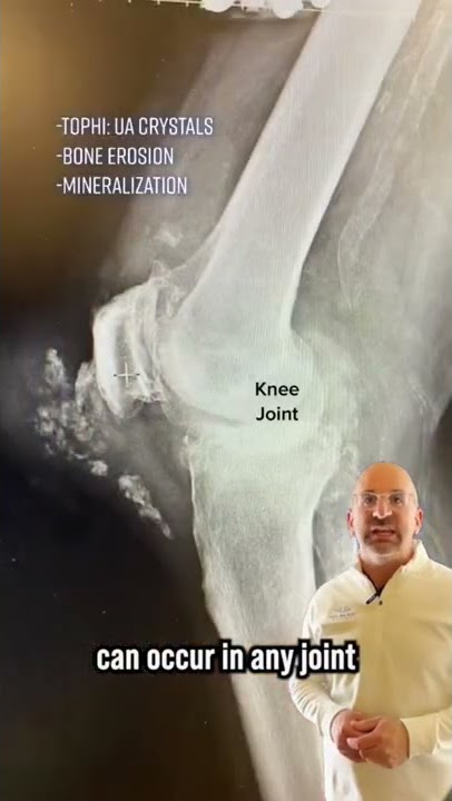 Gout Arthritis causes flares of pain/swelling #kneepain #gout #orthopedics #jointpain #arthritis