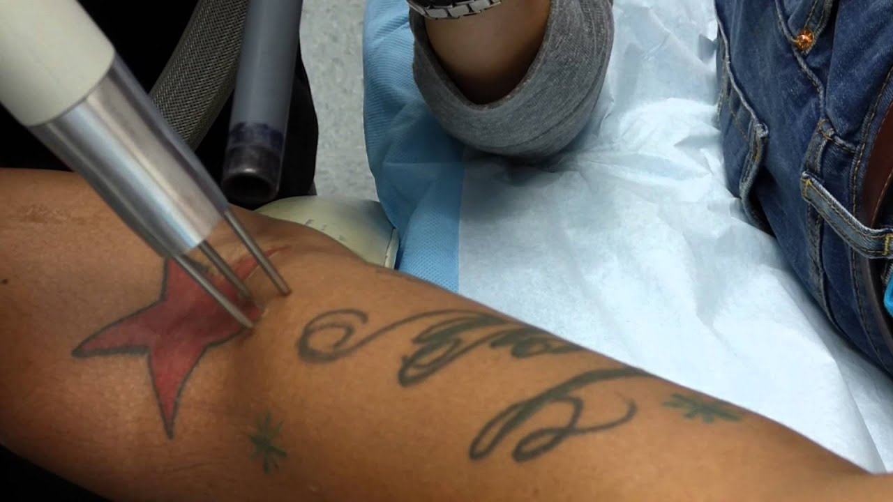 actor rome flynn gets chest tattoo removed youtube actor rome flynn gets chest tattoo removed youtube
