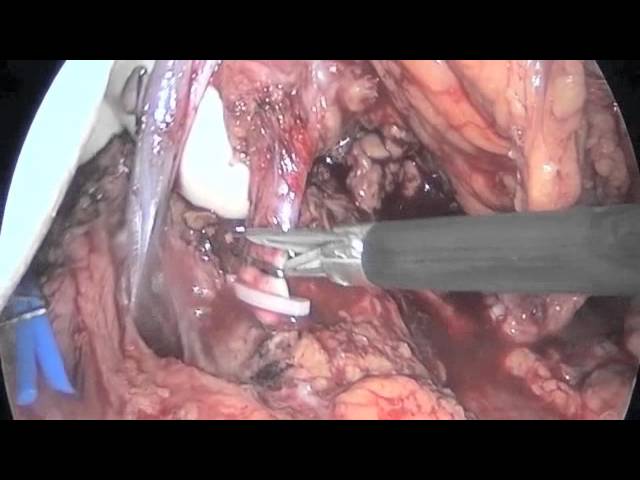 трансплантация поджелудочной и почки в ГКБ№ 7