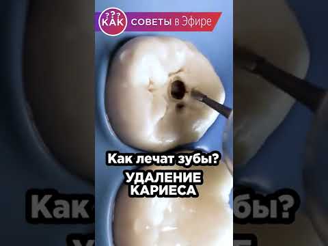 Как лечат зубы? Как удаляют кариес и ставят пломбу с БОЛЬШИМ УВЕЛИЧЕНИЕМ #Shorts