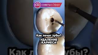 Как лечат зубы? Как удаляют кариес и ставят пломбу с БОЛЬШИМ УВЕЛИЧЕНИЕМ #Shorts