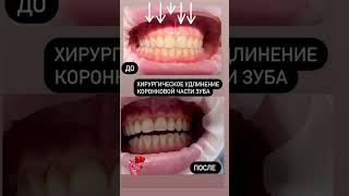 Удлинение зубов? Возможно ?#шортс #зубы #медицина +7495-652-0101