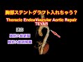 【ステントグラフト】 大動脈解離 TEVAR for Aortic Dissection 血管内治療 【ステント入れちゃう?】