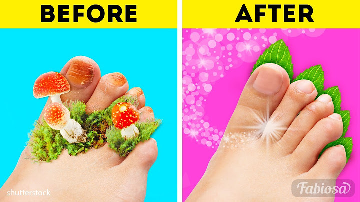 What is the most effective natural treatment for toenail fungus
