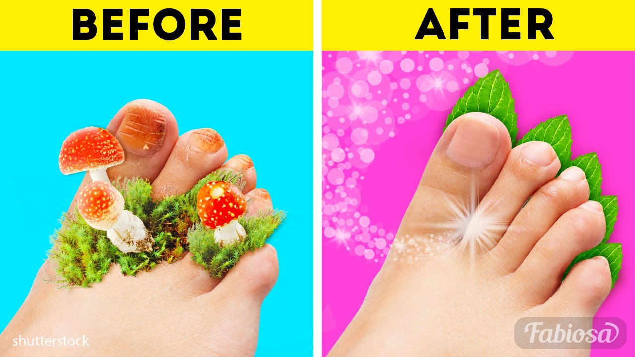 Best home remedies for nail fungus: 7 natural ways to get rid of a nail