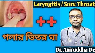 Laryngitis / Sore Throat | গলার ভিতর ঘা | Homeopathy Dr. Advice in Bengali | @DrAniruddhaDe