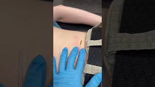 Dry needling for low back spasms