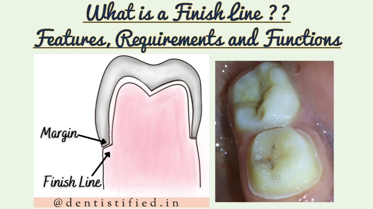 finish-lines-in-fixed-partial-denture-finish-lines-in-tooth
