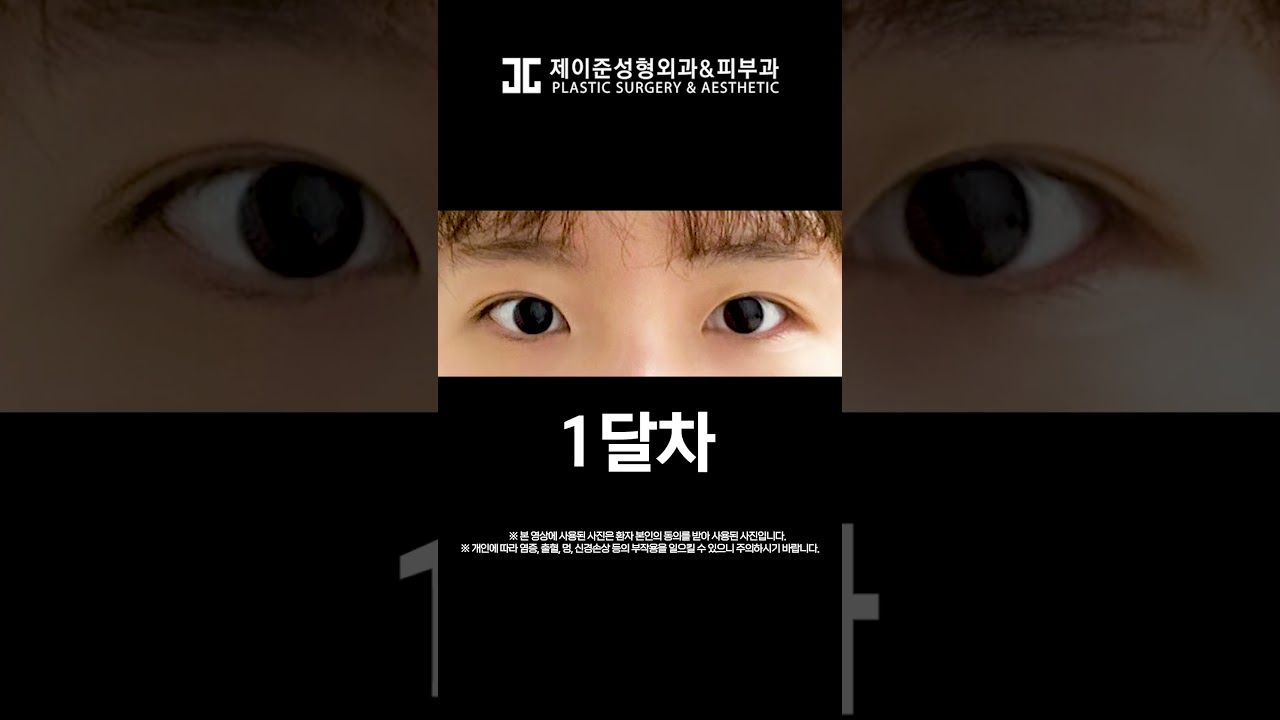 [JAYJUN Phẫu thuật thẩm mỹ Da] Tạo mắt đẹp không cần rạch!!💕 Nâng cơ mắt không phẫu thuật #shorts