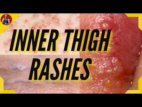 Rashes Between Legs Causes & Treatment - How To Treat Inner Thigh Rash?
