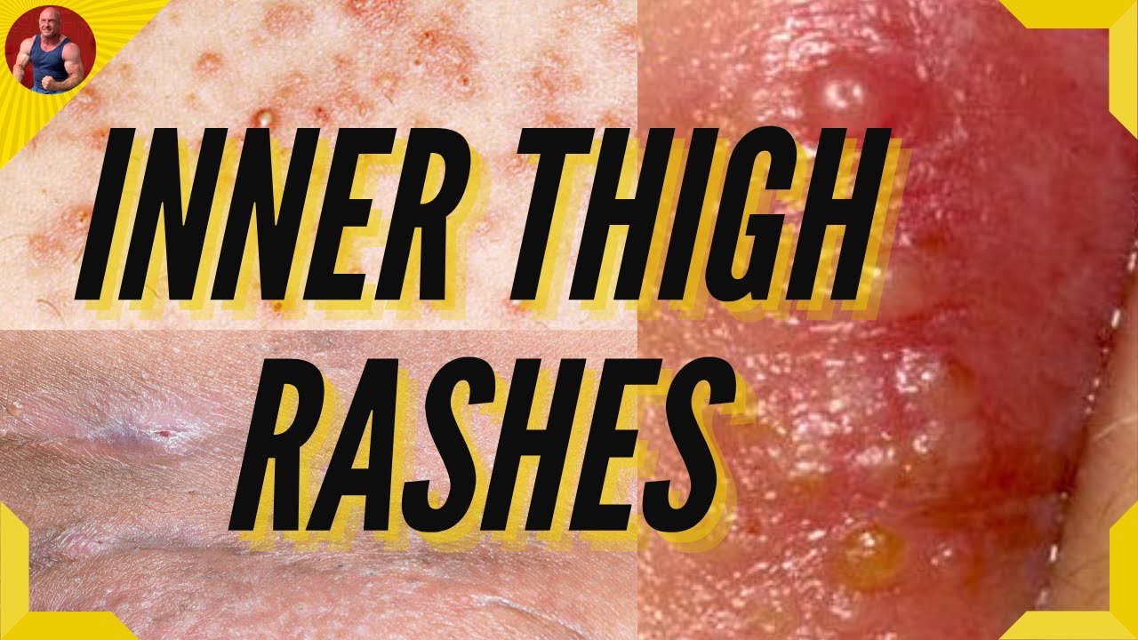 Rashes Between Legs Causes & Treatment - How To Treat Inner Thigh