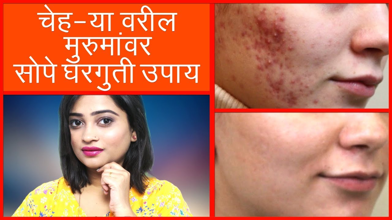 at home remedies for cystic pimples