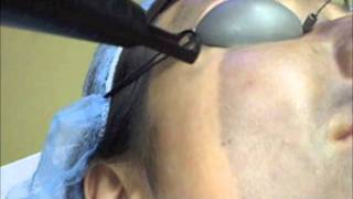 Spectra Laser Treatment