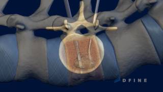 Treatment of spine cancer without surgery  علاج سرطان العمود الفقري بدون جراحة