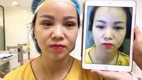 Kết Quả Cắt Mí Mani Mini Deep 5D Tại Dr.Hải Lê