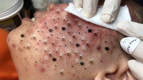 Blackheads Removal | Acne Treatment and Very Satisfying Satisfying Pimple pop 鼻角栓,ピンセット,피지제거_