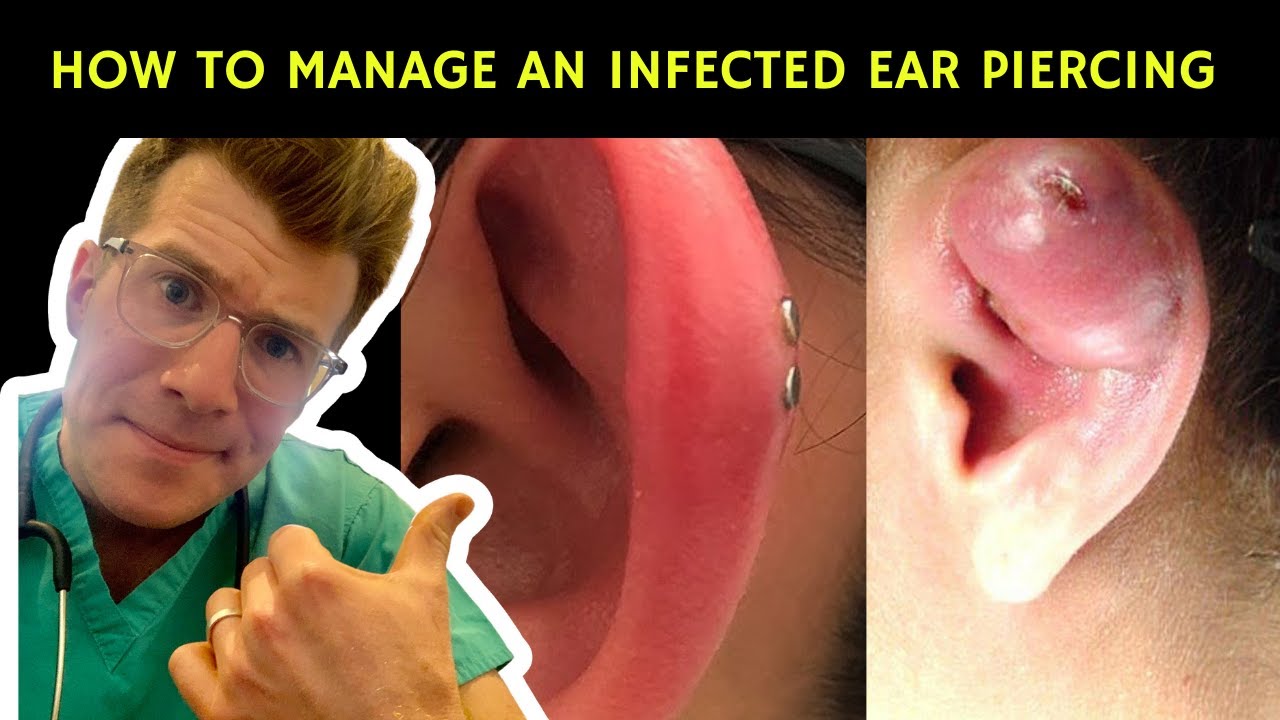 Ear Piercing In Chhindwara - Cozmoderm Clinic
