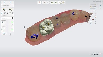 3Shape TRIOS Design Studio -  仮想咬合器について