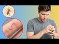 Stop night itching Permanently — Doctor’s Step-by-Step Plan for Scabies