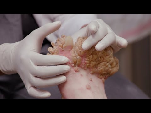 Video: Man-tree: Even 24 Operations Did Not Help The Man To Get Rid Of Unusual Growths On The Skin - Alternative View