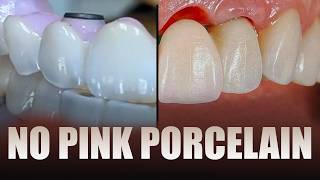 Hygenic Full-Mouth Zirconia Solution Without Pink Color