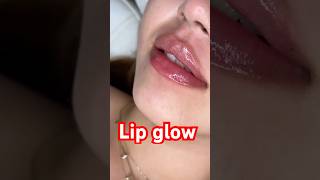 Lip Filler Transformation | Natural Russian Technique | Before & After #montrealbeauty