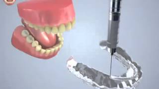Chirurgie ethetique tunisie   Blanchiment des dents Gouttière