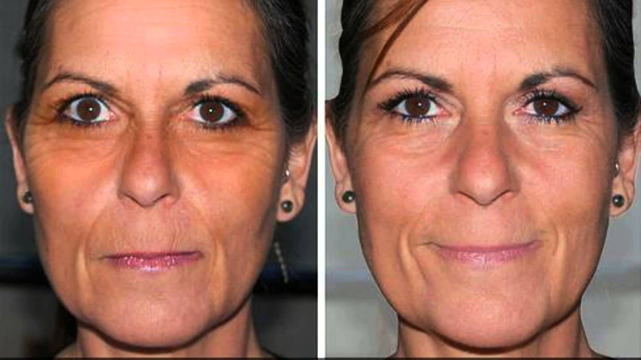 Phytoceramides before and after