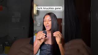 Dark knuckles shouldn’t be a problem in 2026! #skincare #darkknuckletreatment #skindeep #complexion