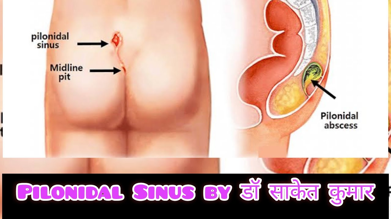 #Pilonidal